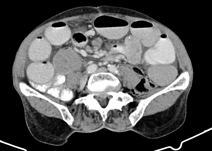 Acute small bowel (ileal) volvulus (Radiopaedia 71740-82139 Axial C+ portal venous phase 133).jpg