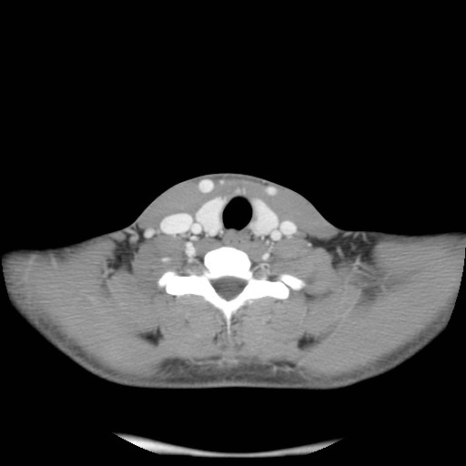 File:Acute submandibular sialadenitis secondary to ductal stone (Radiopaedia 27999-28267 Axial C+ delayed 38).jpg