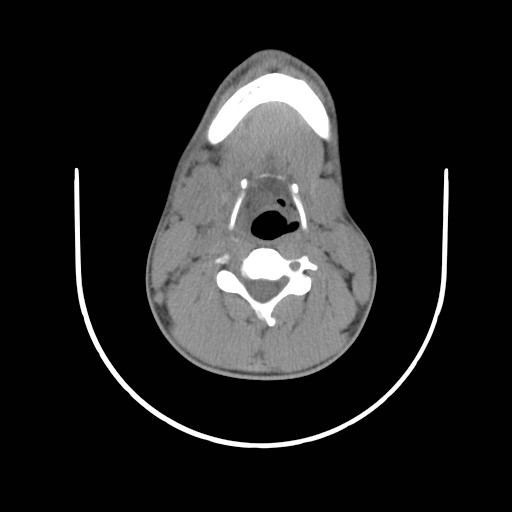 File:Acute submandibular sialadenitis secondary to ductal stone (Radiopaedia 27999-28267 Axial non-contrast 16).jpg