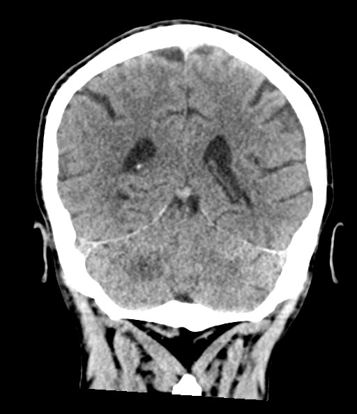 Acute superior cerebellar artery territory infarct (Radiopaedia 84104-99359 Coronal non-contrast 63).jpg