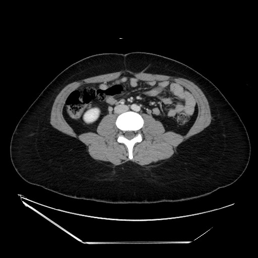 Acute uncomplicated appendicitis (Radiopaedia 73704-84499 Axial C+ portal venous phase 85).jpg