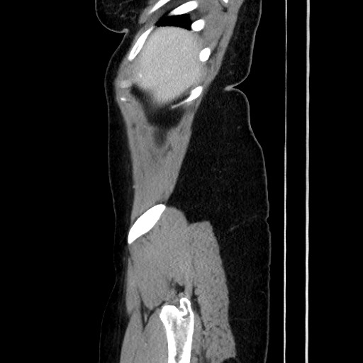 Acute uncomplicated appendicitis (Radiopaedia 73704-84499 Sagittal C+ portal venous phase 52).jpg
