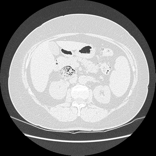 Adenocarcinoma in situ of lung (Radiopaedia 38685-40829 B 255).png