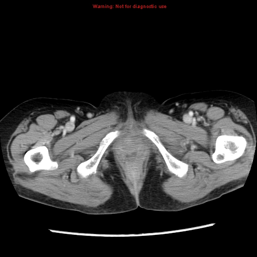 File:Adenocarcinoma of the colon (Radiopaedia 8191-9039 Axial liver window 80).jpg