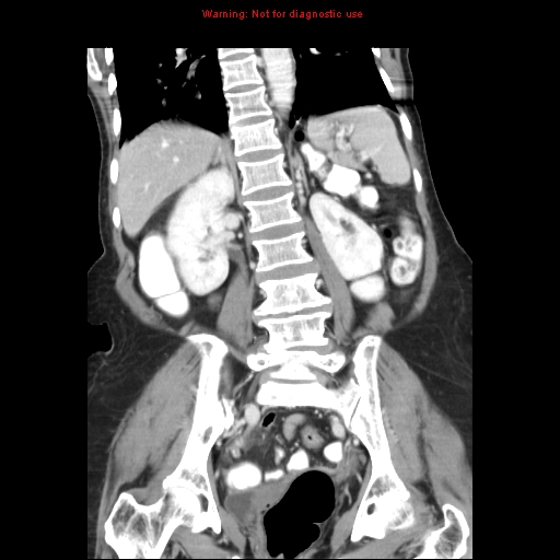 File:Adenocarcinoma of the colon (Radiopaedia 8191-9039 Coronal liver window 30).jpg