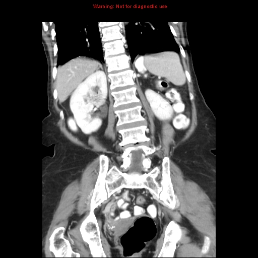 File:Adenocarcinoma of the colon (Radiopaedia 8191-9039 Coronal liver window 33).jpg