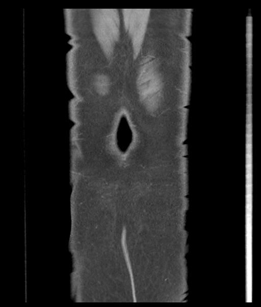 Adenocarcioma of rectum- T1 lesion (Radiopaedia 36921-38547 Coronal C+ portal venous phase 62).png