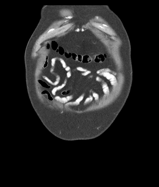 Adenocarcioma of rectum- T1 lesion (Radiopaedia 36921-38547 Coronal C+ portal venous phase 7).png