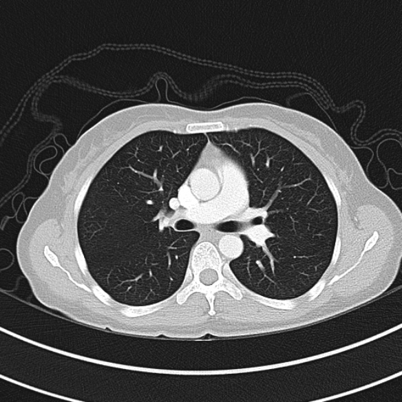 File:Adenocystic carcinoma of the trachea (Radiopaedia 47677-52525 Axial lung window 49).jpg