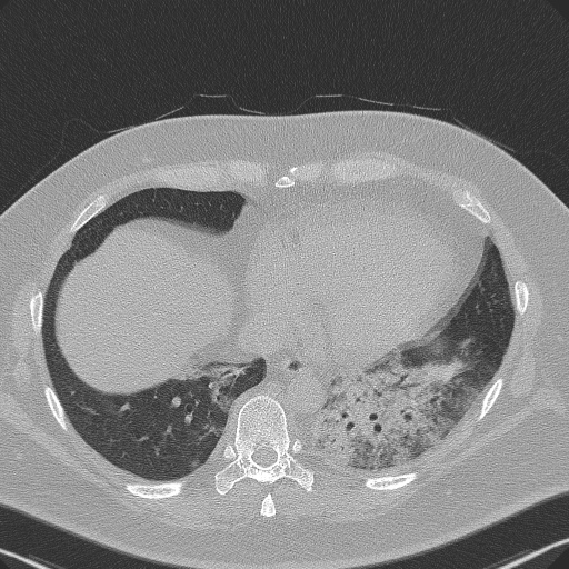 Adenoid cystic carcinoma of the trachea (Radiopaedia 49042-54137 Axial lung window 260).jpg
