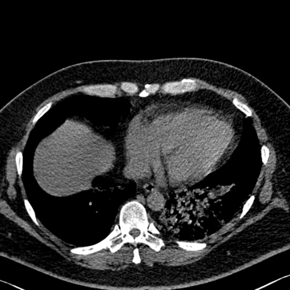 File:Adenoid cystic carcinoma of the trachea (Radiopaedia 49042-54137 Axial non-contrast 256).jpg