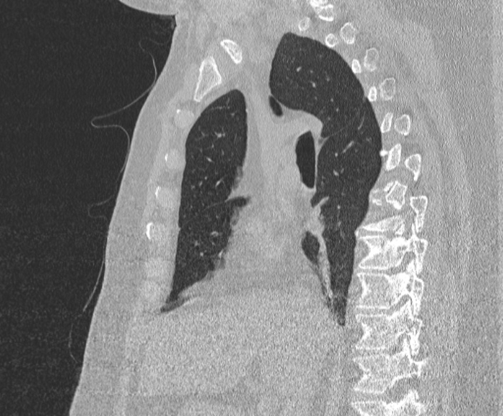 File:Adenoid cystic carcinoma of the trachea (Radiopaedia 49042-54137 Sagittal lung window 205).jpg