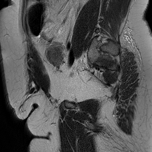 File:Adenomyosis within a didelphys uterus (Radiopaedia 70175-80215 Sagittal T2 9).jpg