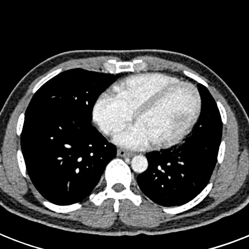 File:Adhesional small bowel obstruction (Radiopaedia 58900-66131 Axial C+ portal venous phase 1).jpg