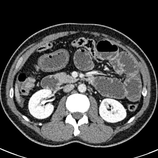 Adhesional small bowel obstruction (Radiopaedia 58900-66131 Axial C+ portal venous phase 21).jpg