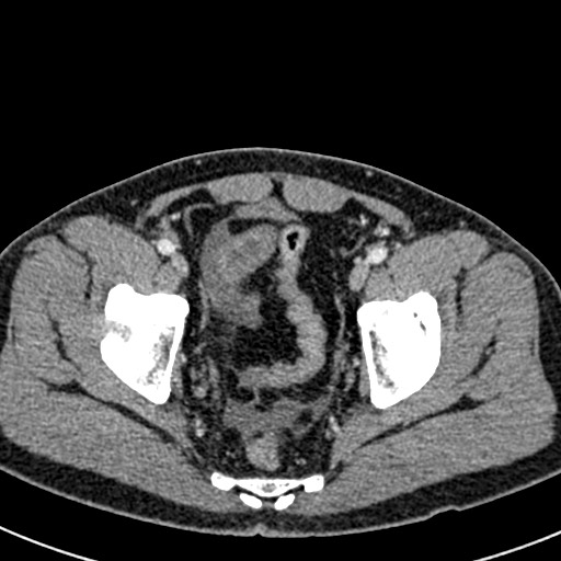 Adhesional small bowel obstruction (Radiopaedia 58900-66131 Axial C+ portal venous phase 48).jpg