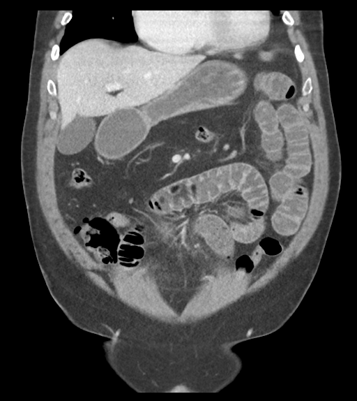 File:Adhesions within abdominal wall hernia (Radiopaedia 58283-65394 Coronal C+ portal venous phase 26).png