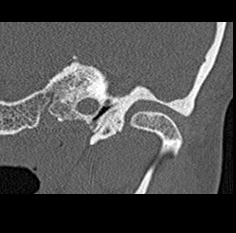 File:Adhesive chronic otitis media (Radiopaedia 14270-14148 Coronal bone window - left 6).jpg