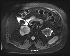 Adrenal cortical carcinoma (Radiopaedia 64017-72770 Axial DWI 17).jpg