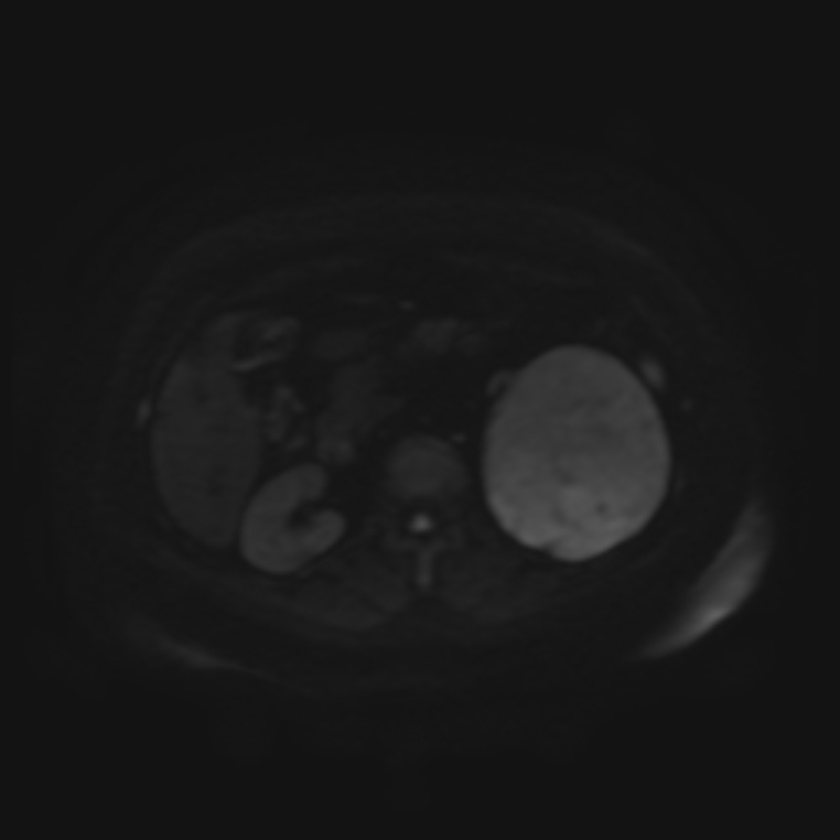 Adrenal cortical carcinoma (Radiopaedia 70906-81116 Axial DWI 43).jpg