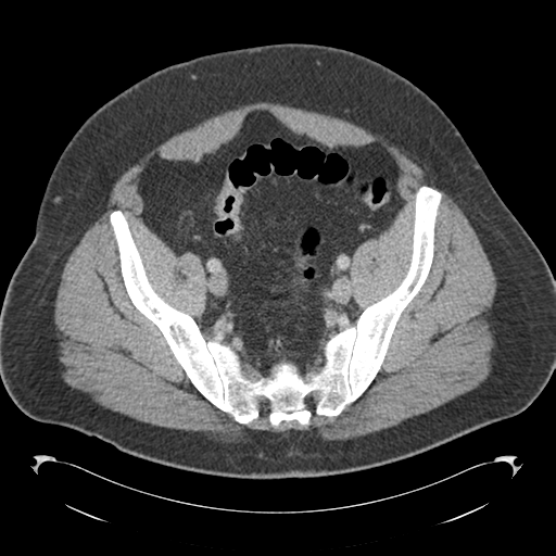 Adrenal cyst (Radiopaedia 45625-49776 Axial C+ portal venous phase 79).png