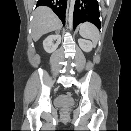 Adrenal cyst (Radiopaedia 45625-49776 Coronal C+ portal venous phase 49).png