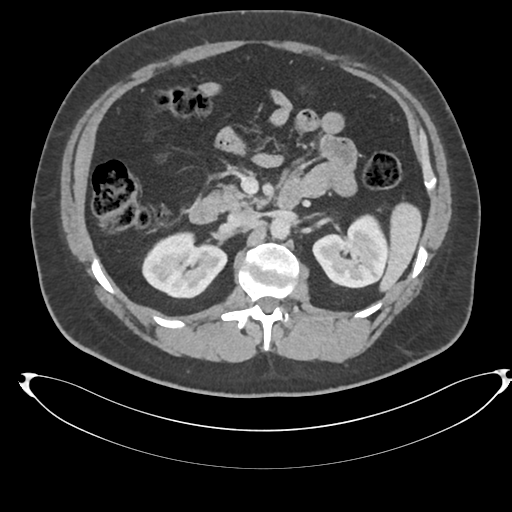 File:Adrenal cyst (Radiopaedia 45625-49778 AXIAL THICK 60 sec 32).png