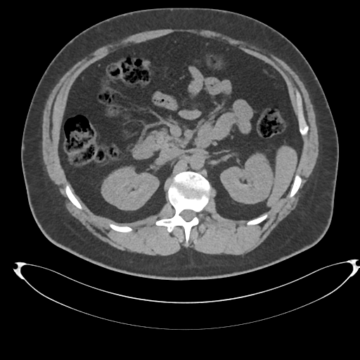Adrenal cyst (Radiopaedia 45625-49778 Axial non-contrast 43).png