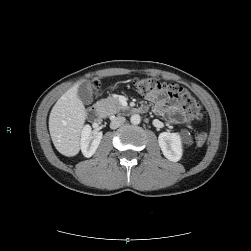 Adrenal cystic lymphangioma (Radiopaedia 83161-97534 Axial C+ portal venous phase 40).jpg