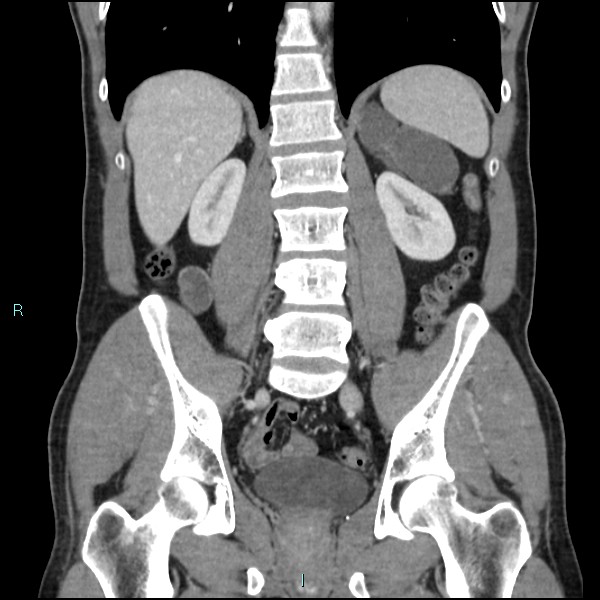 Adrenal cystic lymphangioma (Radiopaedia 83161-97534 Coronal C+ portal venous phase 49).jpg