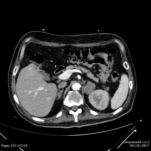 Adrenal metastasis (Radiopaedia 78425-91079 Axial C+ arterial phase 31).jpg