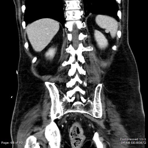 Adrenal metastasis (Radiopaedia 78425-91079 Sagittal C+ portal venous phase 55).jpg