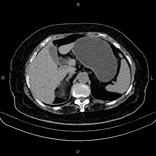 Adrenal myelolipoma (Radiopaedia 82742-96986 Axial non-contrast 37).jpg