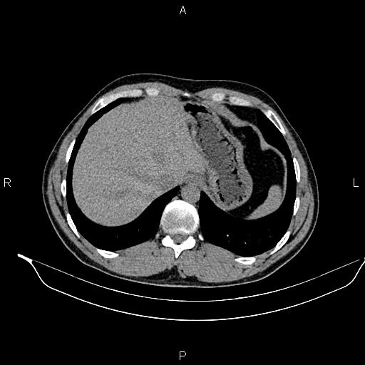 Adrenal myelolipoma (Radiopaedia 87794-104246 Axial non-contrast 18).jpg