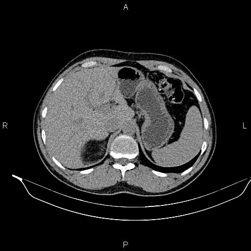 File:Adrenal myelolipoma (Radiopaedia 87794-104246 Axial non-contrast 25).jpg