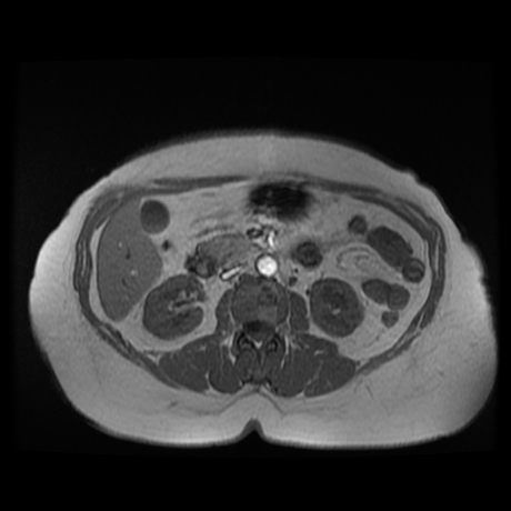 File:Adrenal myelolipoma - MRI (Radiopaedia 83249-97646 Axial T1-in phase 17).jpg