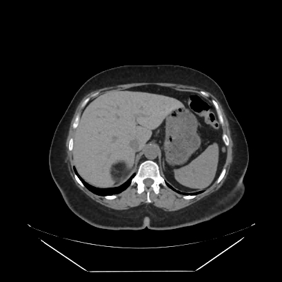 Adrenal myelolipoma - MRI (Radiopaedia 83249-97647 Axial non-contrast 5).jpg