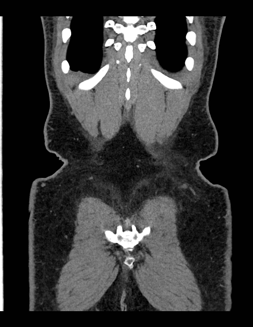 Adrenal myelolipoma - bilateral (Radiopaedia 74805-85810 Coronal C+ portal venous phase 58).jpg