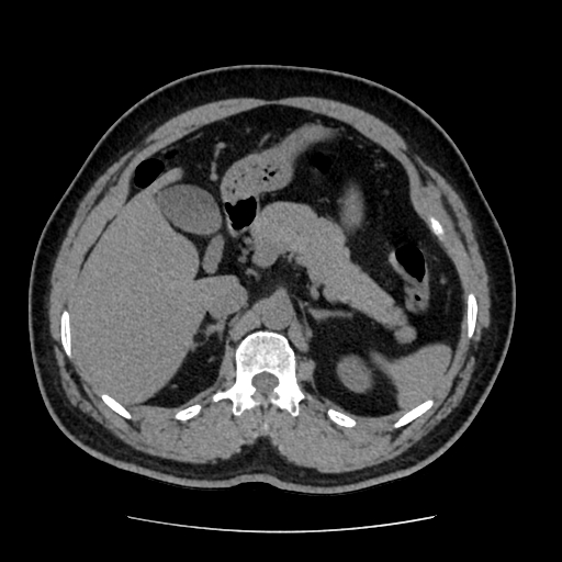 Adrenal myelolipoma and beaver tail liver (Radiopaedia 86201-102193 Axial non-contrast 146).jpg