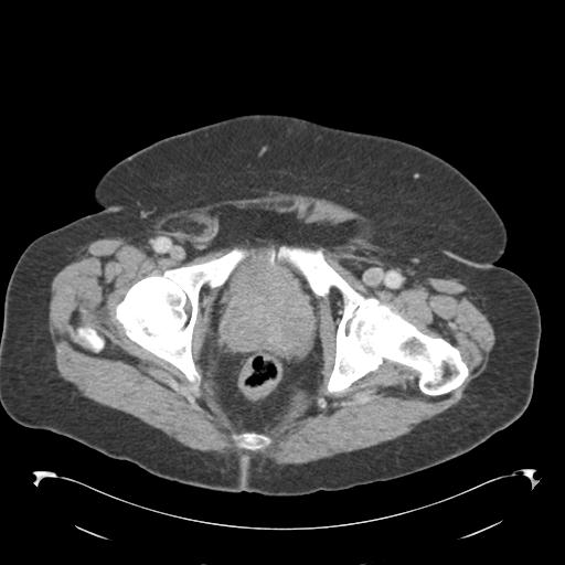 Adult ileal intussusception with secondary obstruction (Radiopaedia 30395-31051 Axial C+ portal venous phase 75).jpg