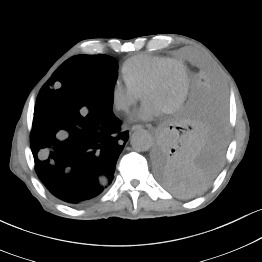 Advanced metastatic lung cancer (Radiopaedia 48910-53954 Axial non-contrast 43).png