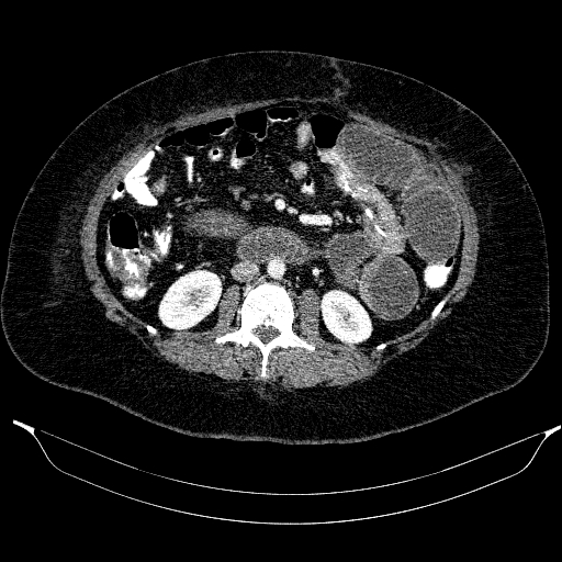 File:Afferent loop syndrome - secondary to incarcerated trocar site hernia (Radiopaedia 82959-97305 Axial C+ portal venous phase 173).jpg