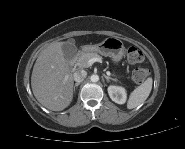 File:Agenesis of the dorsal pancreas (Radiopaedia 11180-11545 Axial 1).jpg