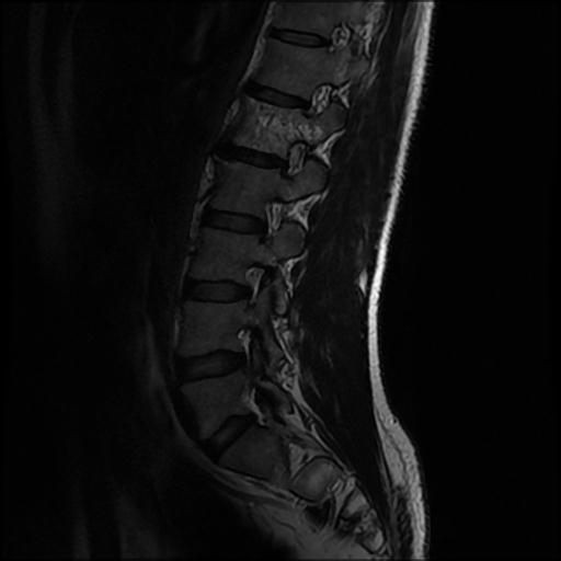 File:Aggressive vertebral hemangioma with pathological fracture (Radiopaedia 69528-79411 Sagittal T2 8).jpg