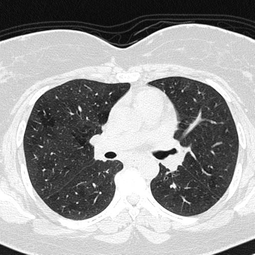 Air trapping in small airway disease (Radiopaedia 61685-69694 Axial lung window 78).jpg