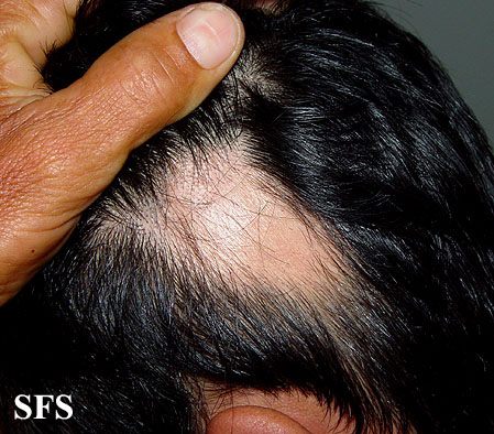 Alopecia Areata (Dermatology Atlas 42).jpg