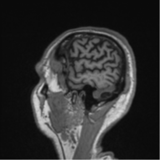 File:Alzheimer's disease- with Gerstmann syndrome and dressing apraxia (Radiopaedia 54882-61150 Sagittal T1 63).png