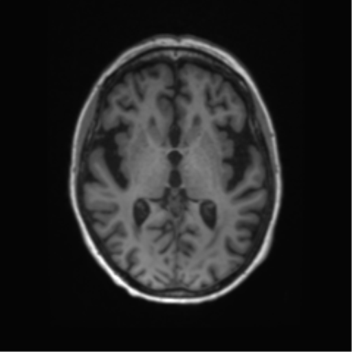 File:Alzheimer's disease (Radiopaedia 42658-45802 Axial T1 81).png
