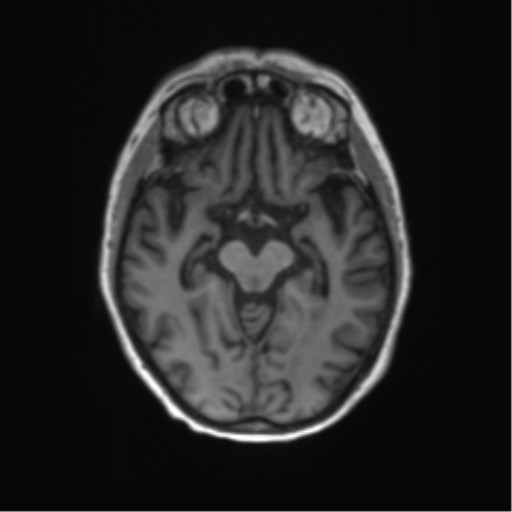 File:Alzheimer's disease (Radiopaedia 42658-45802 Axial T1 92).png