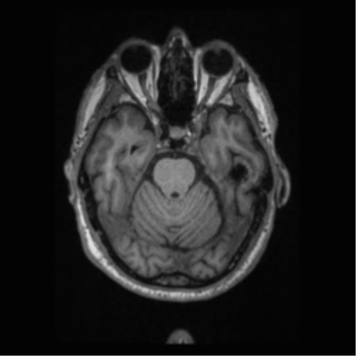 File:Alzheimer disease - probable (Radiopaedia 35334-36837 Axial T1 28).png